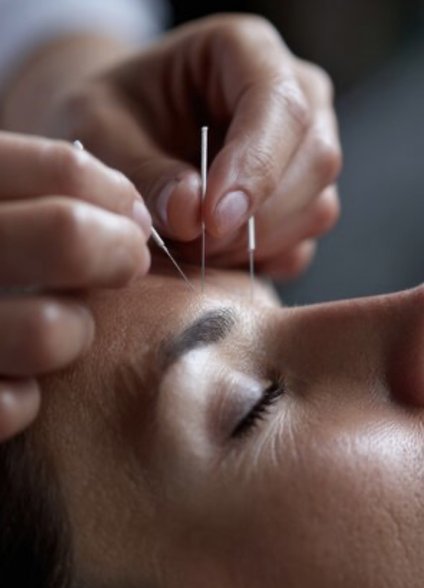 Rajeunissement Facial par l’acupuncture / Acupuncture Facial Rejuvenation Rajeunissement Facial par l’acupuncture / Acupuncture Facial Rejuvenation